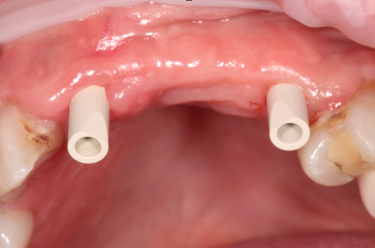 Sin Scan Body Digital restorative dentistry: using intraoral scanning - ITI Blog