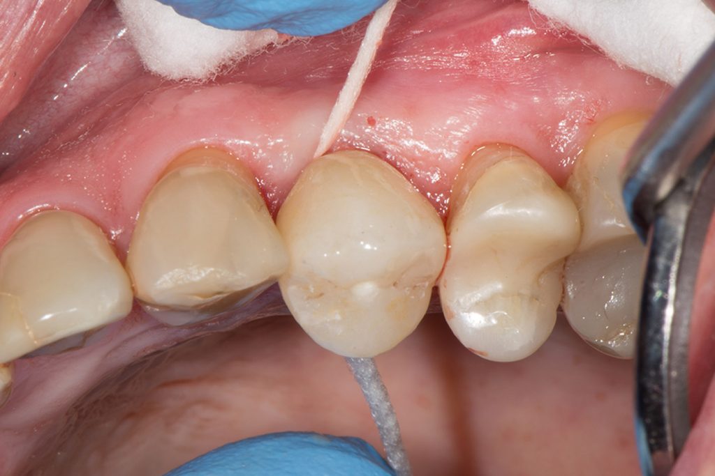 Comparison: zirconia vs. titanium dental implants - ITI Blog