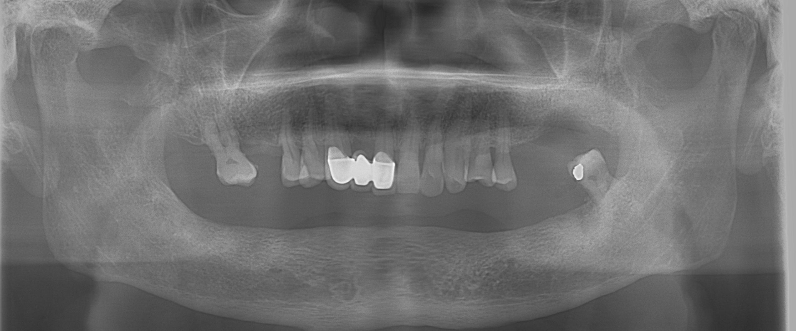 CT scan vs. Cone Beam CT