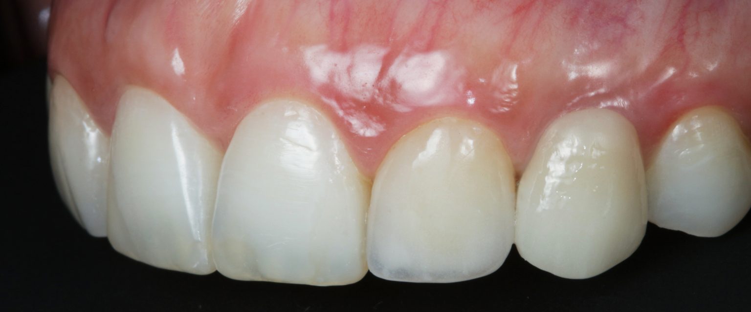 Dental soft tissue management