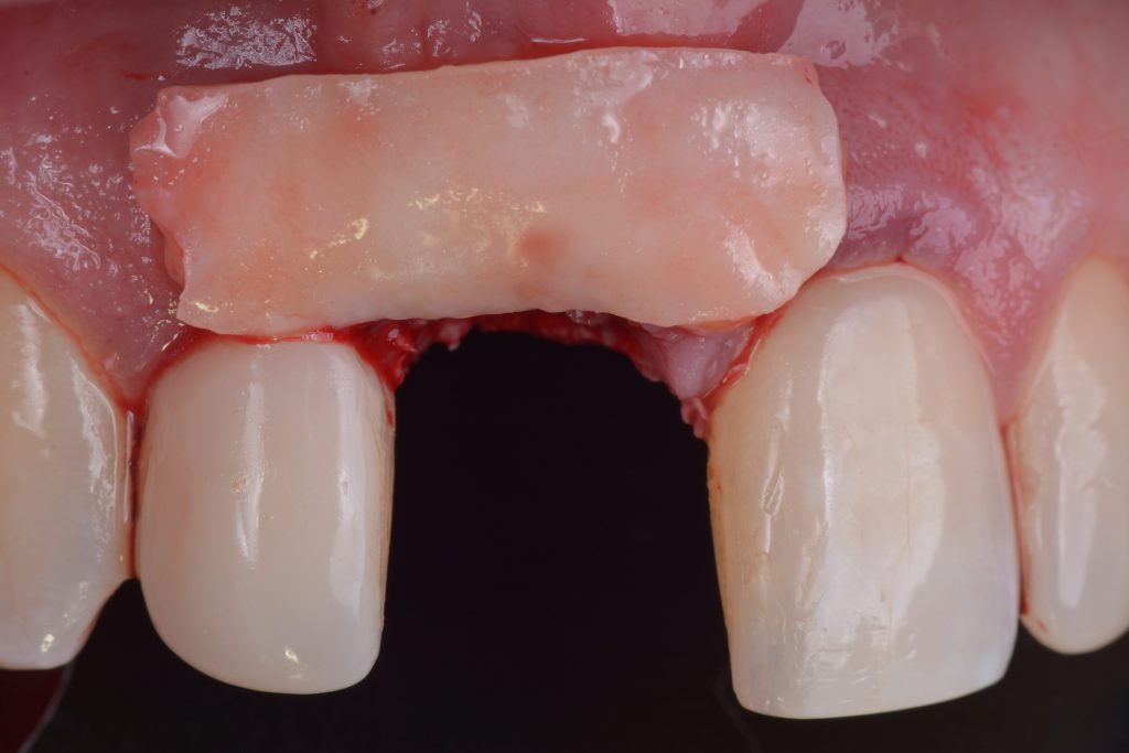 Fig. 1i Connective tissue graft to over-contour the alveolar aspect of the implant