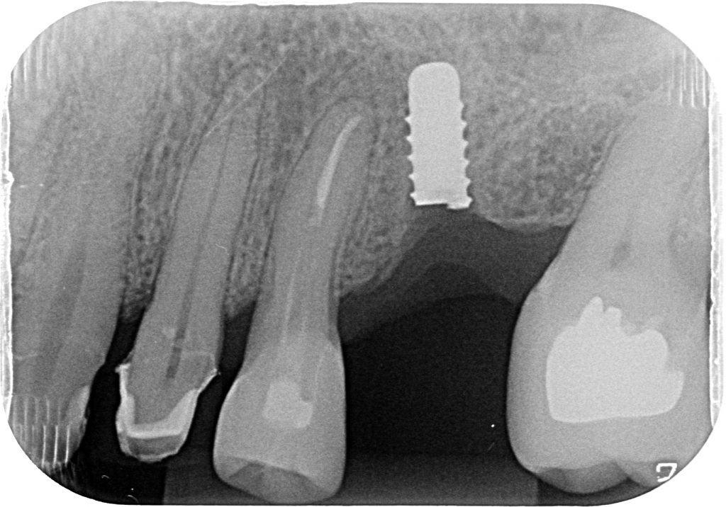 Fig 10a X-ray showing a titanium reduced-diameter fractured implant in the molar region