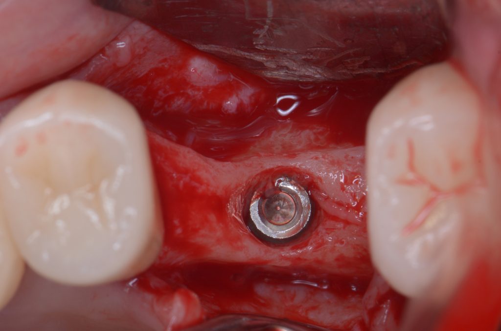 Fig 10b Occlusal view of the fractured implant. In cases like this, it’s impossible for any key to connect inside the implant. So, the removal of this implant has to be done with burs, elevators or trephines. This procedure is usually associated with more bone loss and damage to the surrounding hard tissues