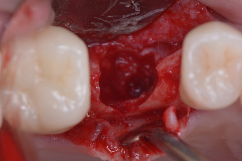 Fig 10e Bone defect after implant removal. The bone defect must be treated immediately with grafts and/or immediate implants in order to avoid the site collapsing