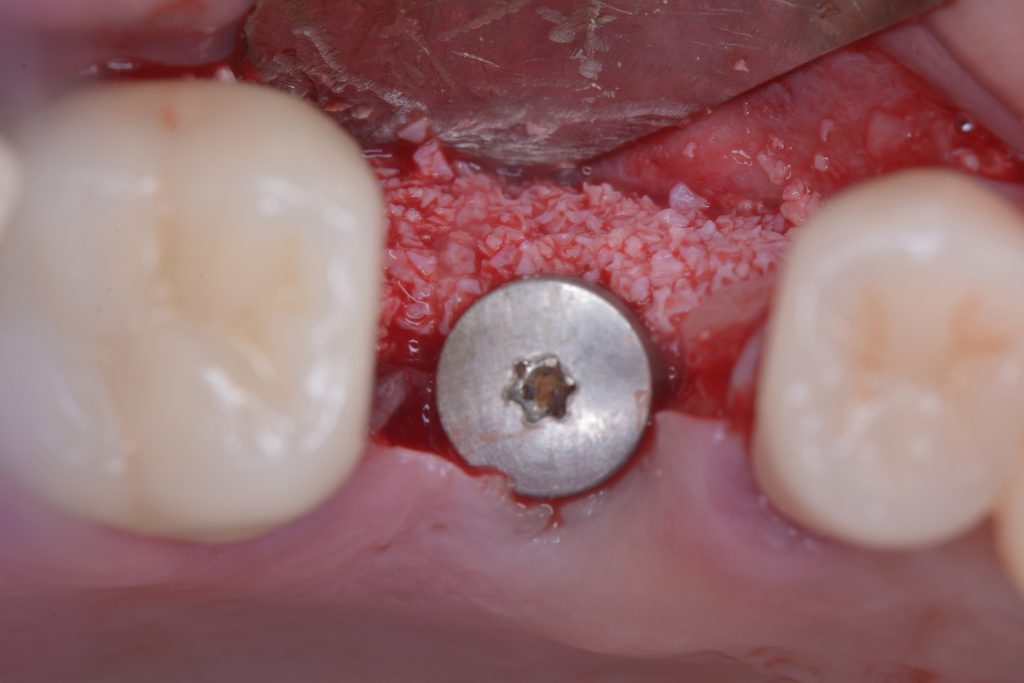 Fig 10f In this case we placed an immediate implant associated with guided bone regeneration (GBR) to replace the failed implant. There was no infection in the site and the buccal bone defect can be predictability regenerated using the GBR technique