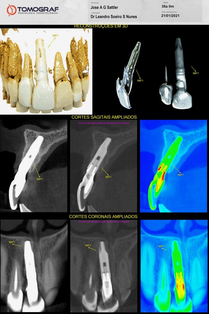 Fig. 1b The CBCT shows the wrong angulation of the implant, which causes an esthetic problem with the screw emerging too buccally