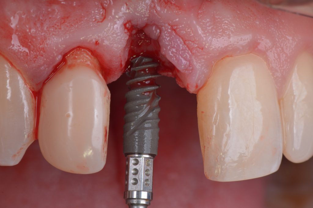 Fig. 1g Immediate implant placement after implant removal. The Straumann BLX implant allows good primary stability, even in compromised sockets