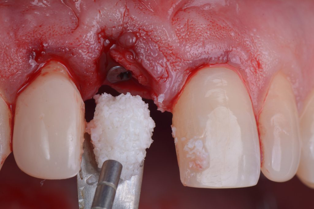 Fig. 1h Xenograft to fill the gap between the implant and the buccal wall