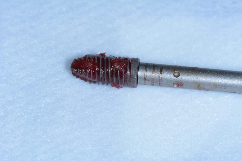 Fig. 2b Failed implant removed with counter-torque wrench