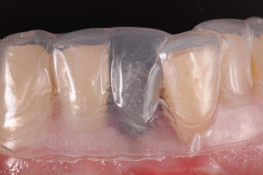 Fig. 4: Titanium temporary abutment is selected and a vacuum-formed matrix verifies whether it is necessary to trim the abutment extra-orally