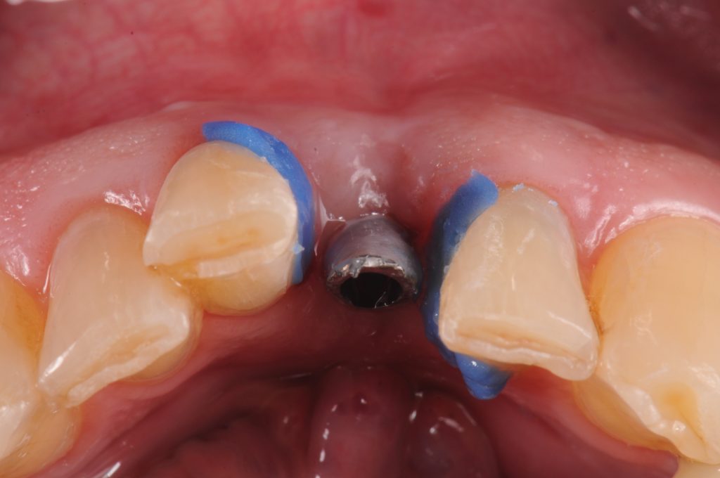 Fig. 5: Titanium temporary abutment after adjusting and opaquing with light cure composite. The interproximal undercuts are blocked out with blue material and screw access protected with Teflon tape. Matrix is filled with Bis-GMA material and seated intra-orally