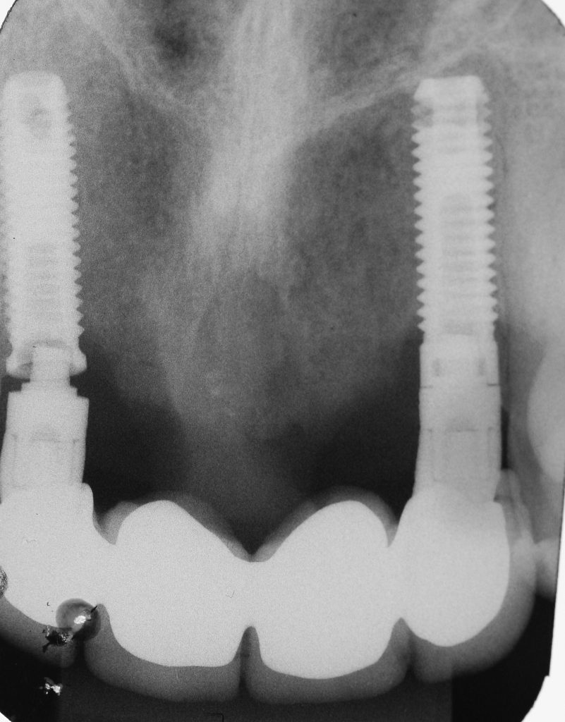 Fig. 5b Periapical x-ray showing one fractured implant and the osseointegration of the malpositioned implants
