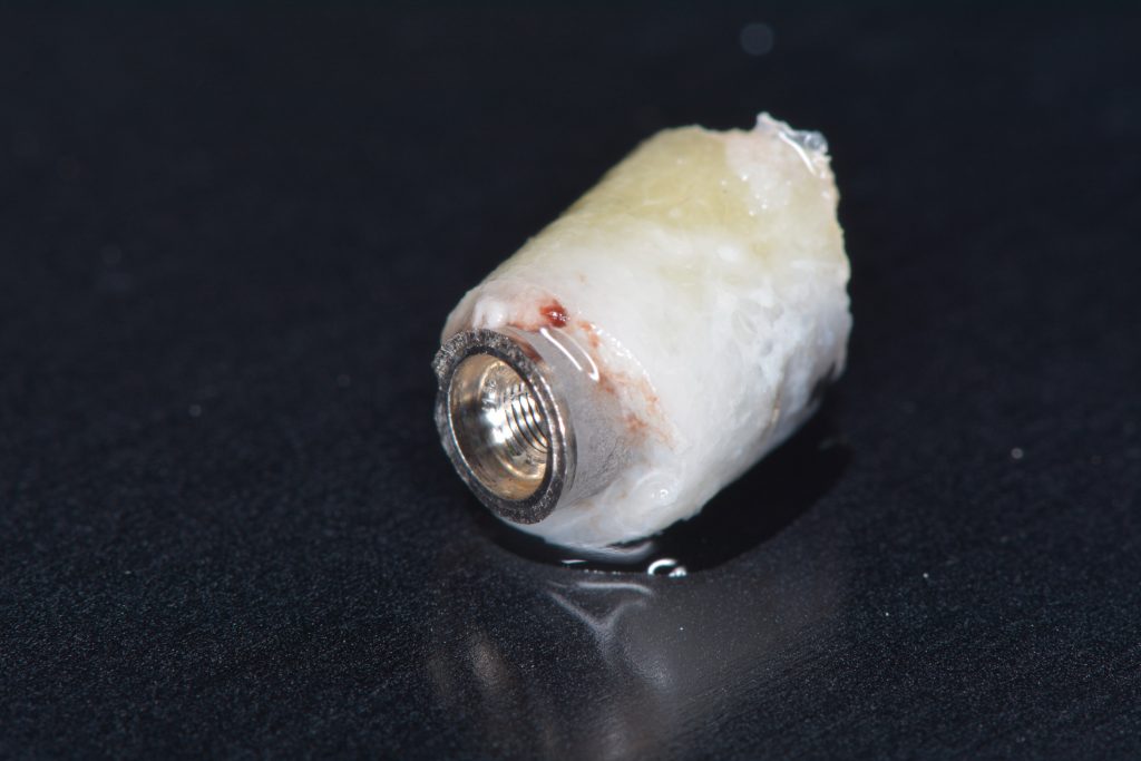 Fig. 6a Removed implant surrounded by bone using a trephine bur