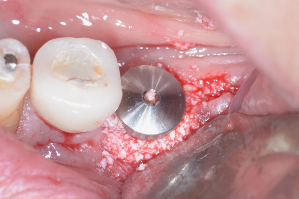 Fig. 6c Immediate implant replacement with guided bone regeneration (GBR)