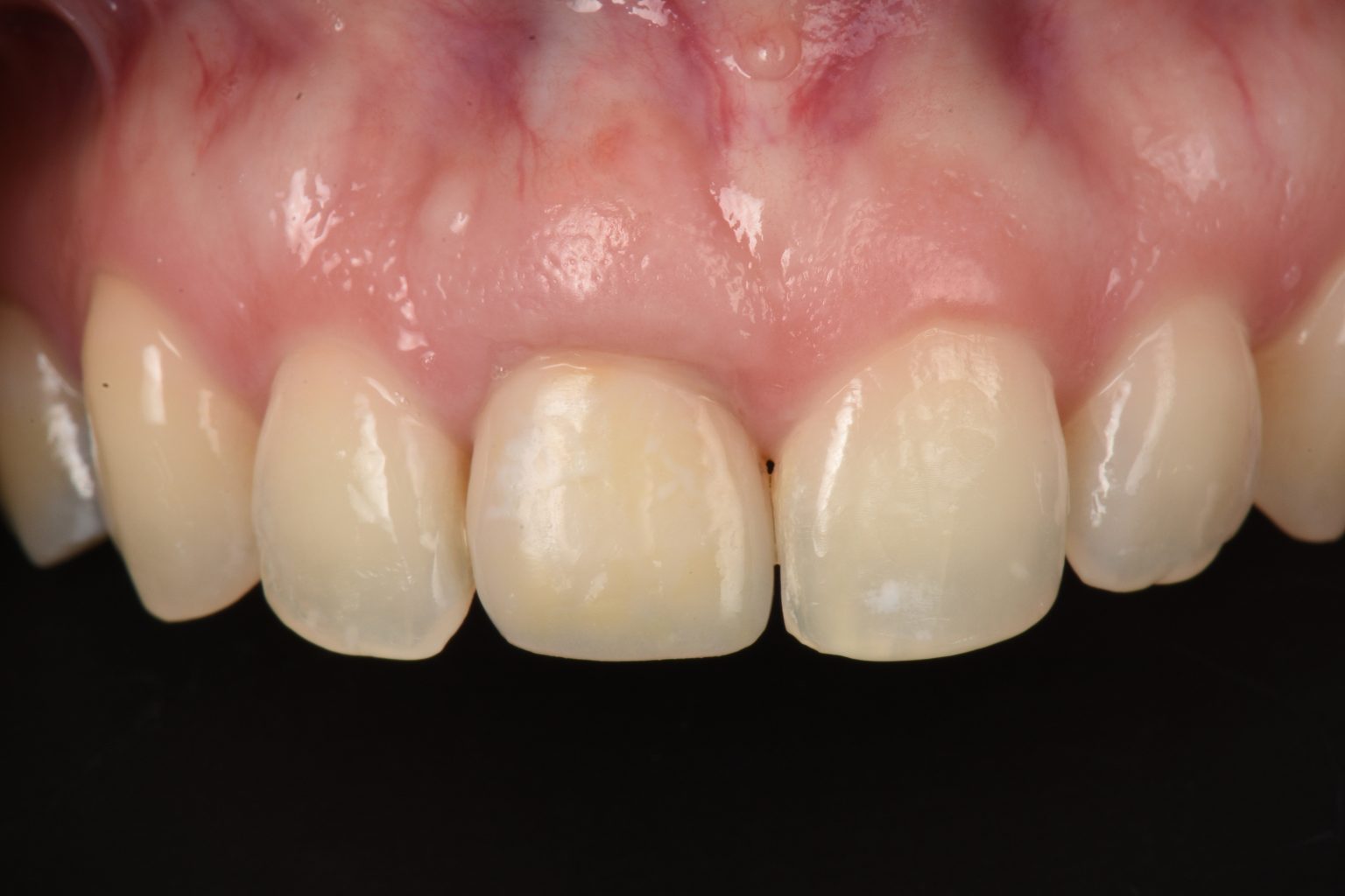 Dental implant-supported transitional prostheses - ITI Blog