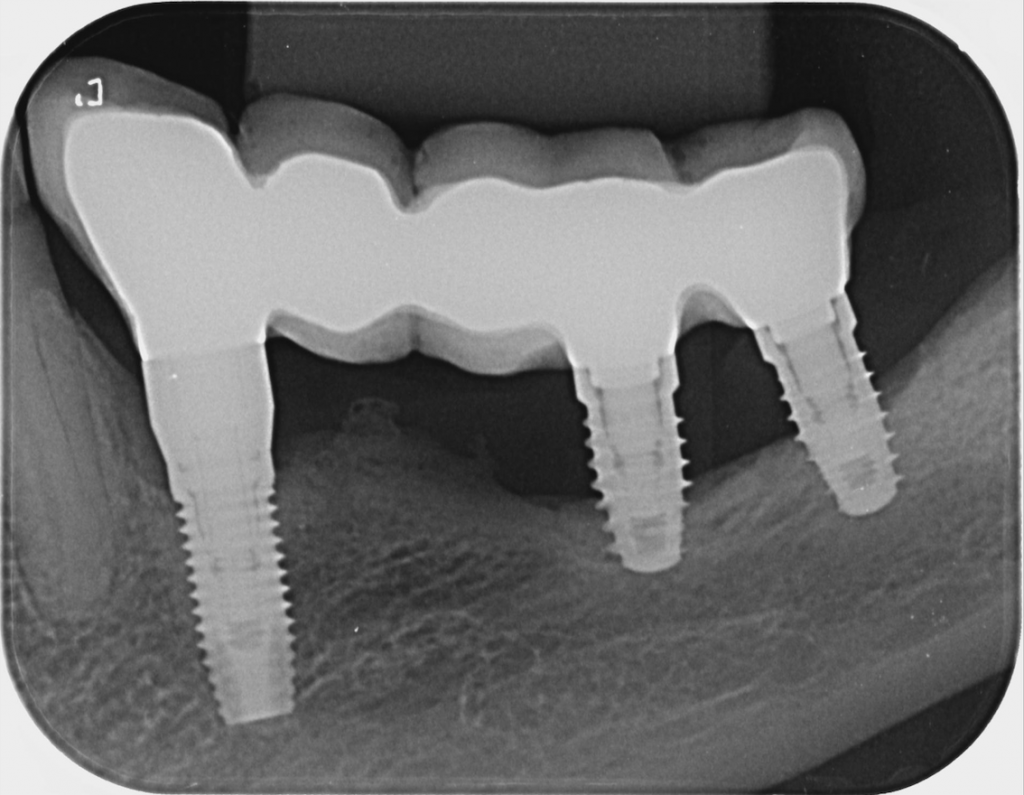 Fig. 9 X-ray showing an implant in a position that is strategically important to the supported prosthesis. In this case, saving and keeping the implant may be more prudent to avoid the failure of the rehabilitation