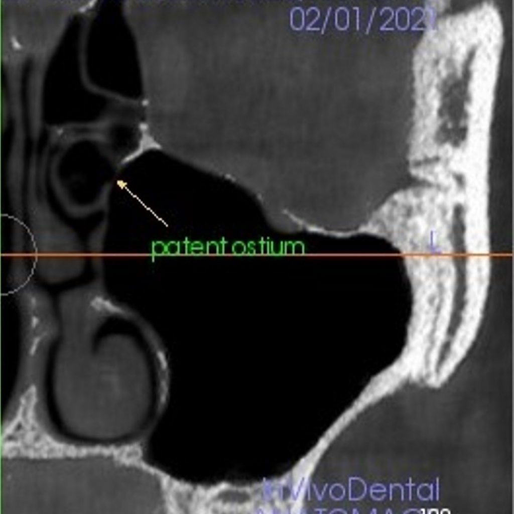 Fig. 1: Coronal reconstructed image of CBCT displaying the left maxillary sinus with a patent ostium. 
