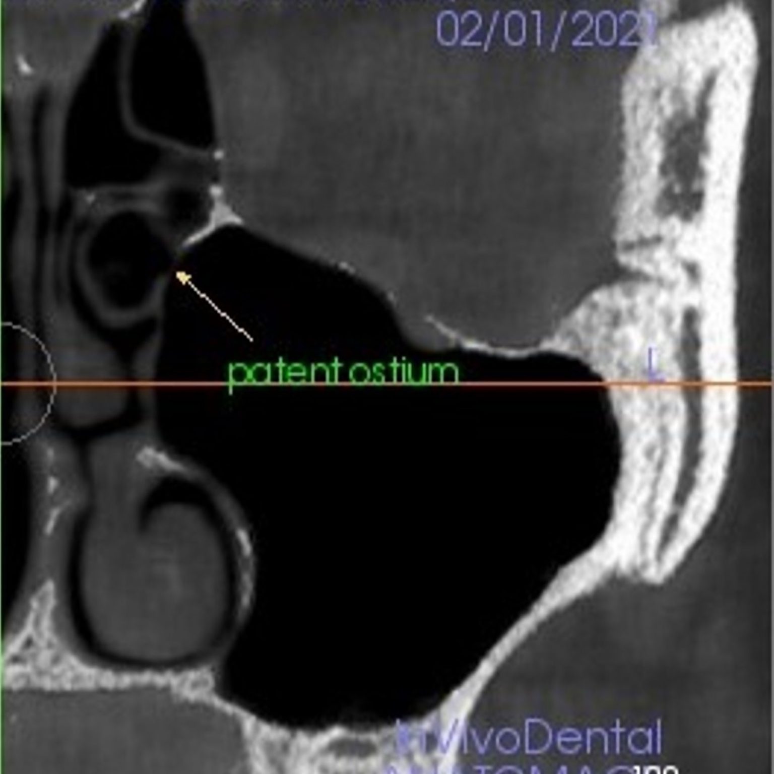 Sinus floor elevation in implant dentistry