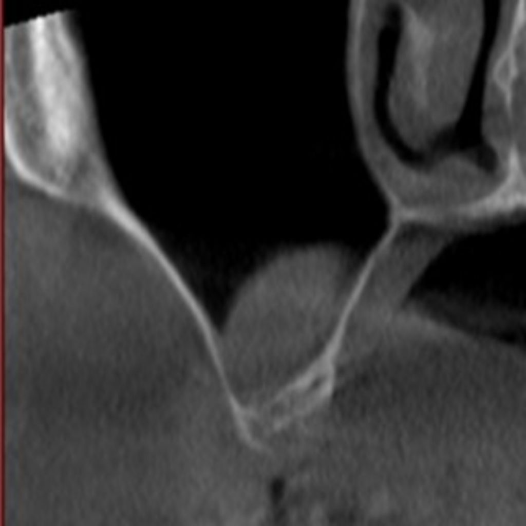 Fig. 2: Coronal reconstructed image of CBCT displaying the thickened sinus floor membrane in the right maxillary sinus indicating underlying pathology.