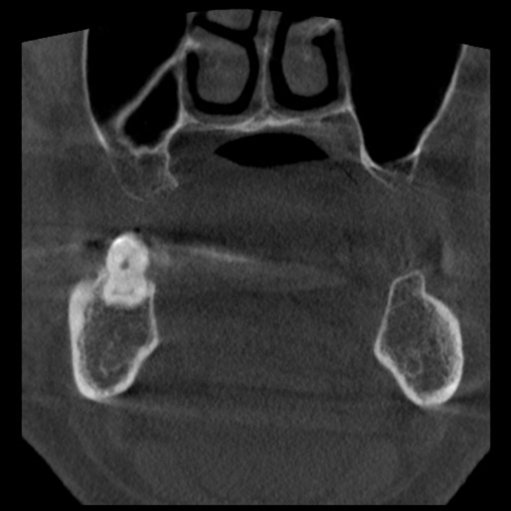 Fig. 3: Coronal reconstructed image of CBCT displaying the presence of an oblique septa in the right maxillary sinus.