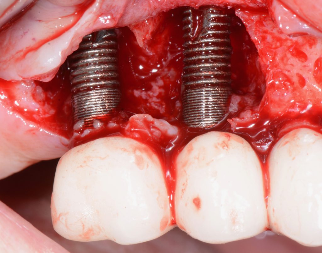 Failing dental implants
