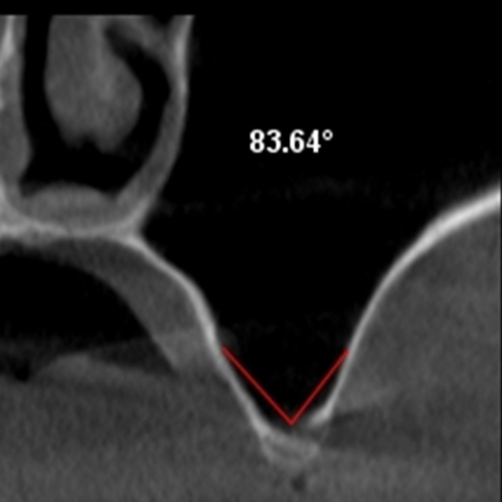 Fig. 4: Coronal reconstructed image of CBCT with angle of  the buccolingual maxillary left sinus wall highlighted. 