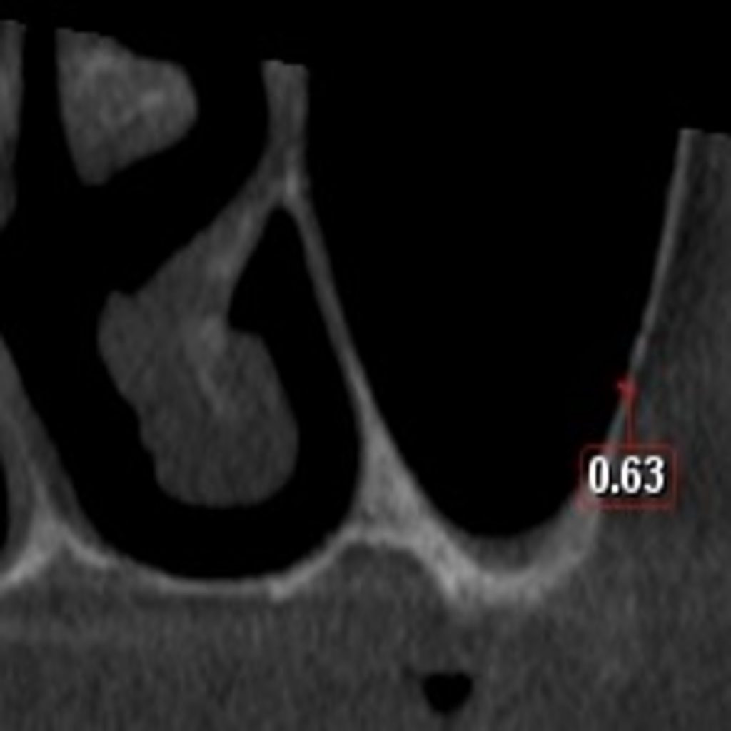 Fig. 5. Coronal reconstructed image of CBCT with thickness of bone on the buccal side, in the region of 26, indicated. 