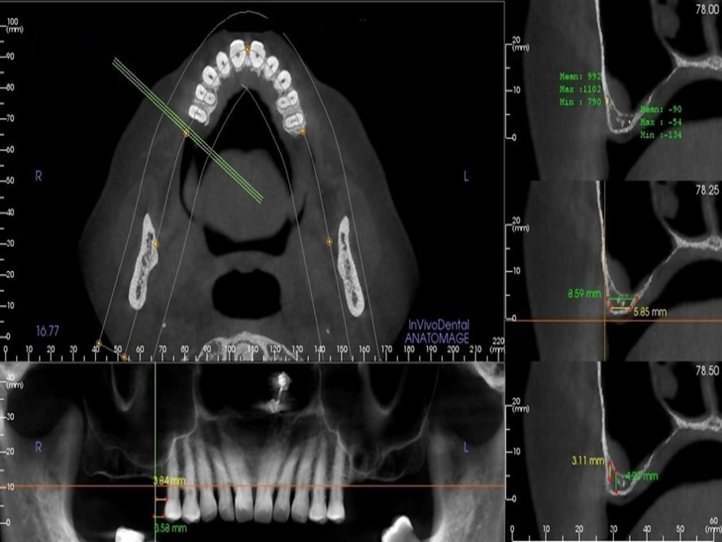 Fig. 6: CBCT showing alveolar ridge dimensions (height and width) in region 16 transversally (right), axially (upper left) and in a panoramic reconstruction (lower left). 