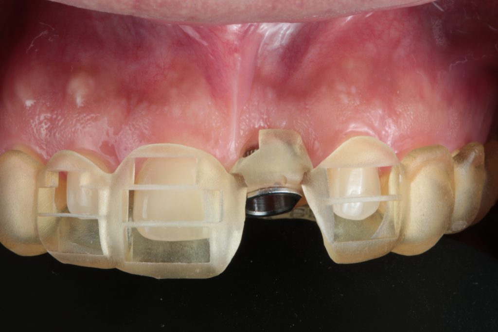 Fig. 1: Fully guided static tooth-supported drill guide including the diagnostic wax-up for prosthodontic accuracy