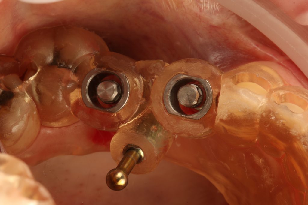 Fig. 2: 3D printed tooth-supported drill guide with a bone anchor pin on the palatal side