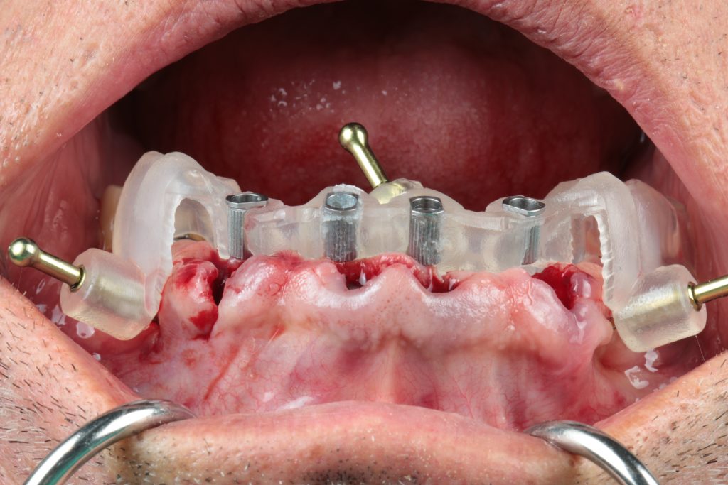 Fig. 3: Static pilot guided surgery with three bone anchor pins for guide stability, two on the buccal and one in the palate. The guide also contains information on the future tooth positions. The buccal of the guide was removed after production