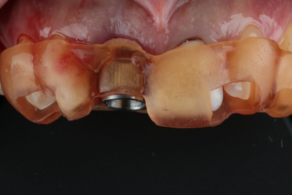 Fig. 4: Tooth-supported guide for fully-guided implant osteotomy and placement. Note the interproximal windows to check the seating of the guide