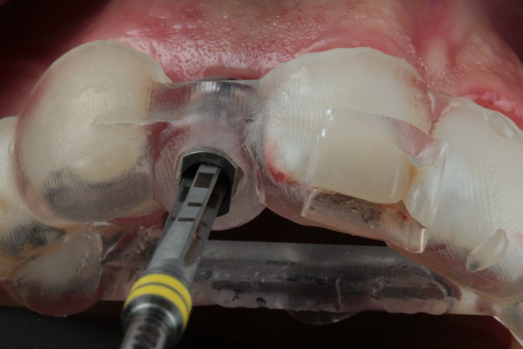 Fig. 6: Pilot drilling static guided surgery