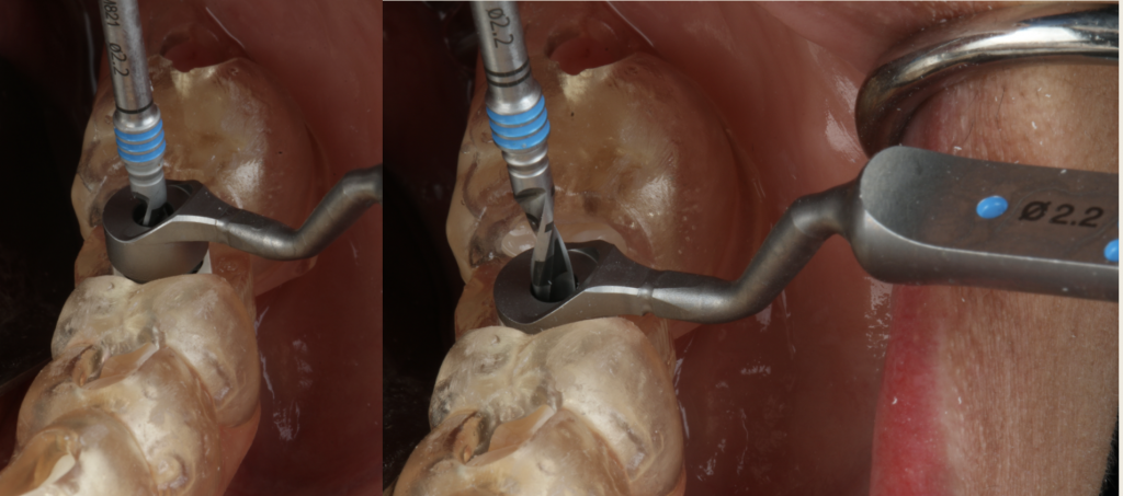 Fig. 7: Fully guided implant placement protocol (Straumann™). The left image shows drilling with the +3 mm key and the right image drilling with the 1 mm key