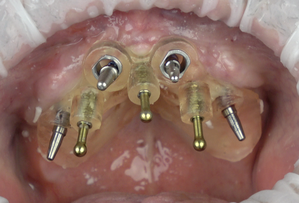 Removal of dental implants: review of five different techniques