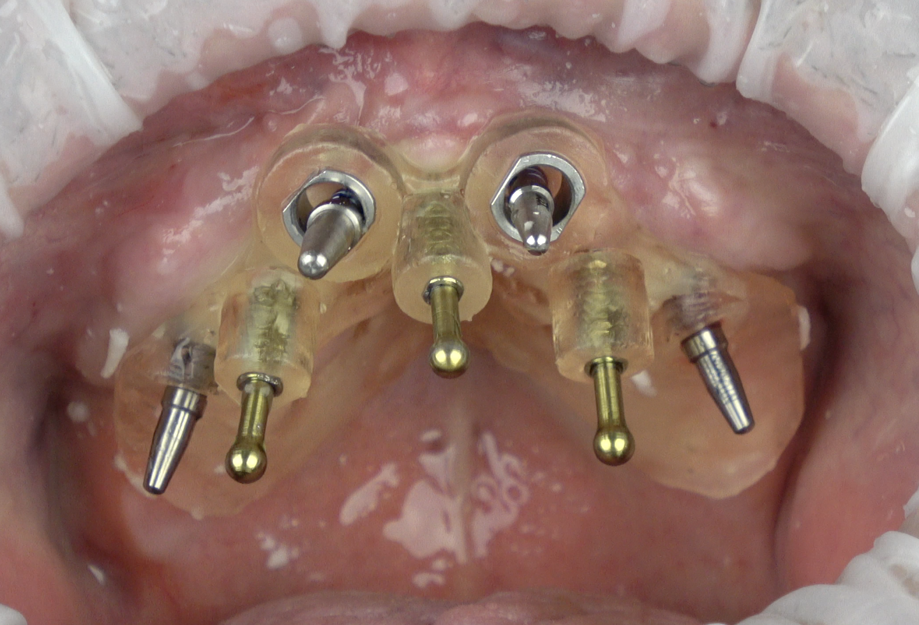 Fig. 9: Full-arch implant-supported rehabilitation with three bone anchor pins on the palate, two posterior sleeveless holes for 16-mm implants and two anterior sleeves for fully digital implant placement. Note that the buccal portion of the guide was cut in postproduction to allow visibility of the surgical field