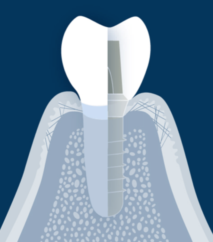 Fig. 1: ITI stock image to demonstrate a tooth and implant and their anatomical differences 