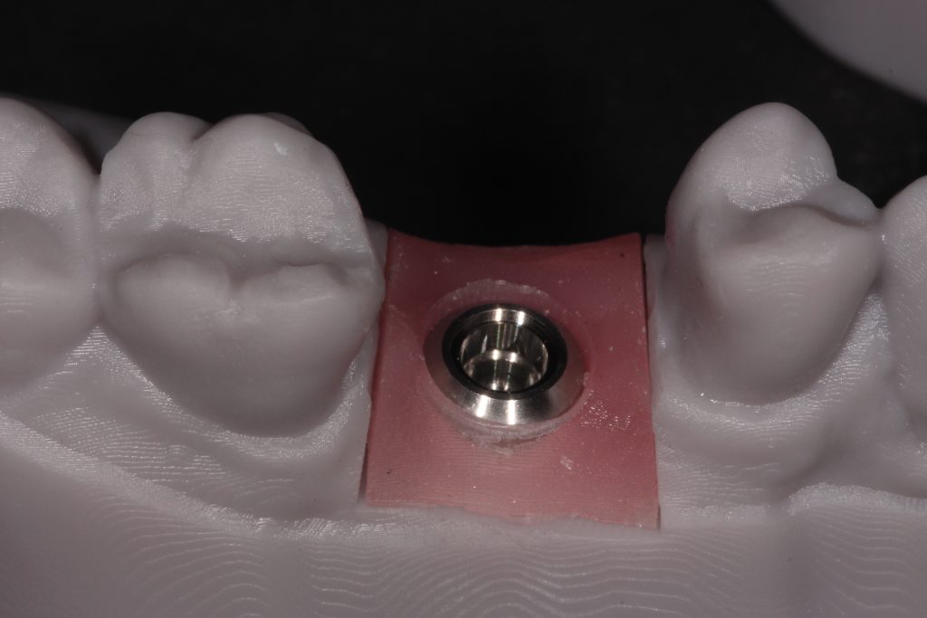 Fig. 10: Implant fixture analog in a printed model to demonstrate the clarity of the restorative margin with a tissue level implant making ease of restoration for marginal fit accuracy a certainty
