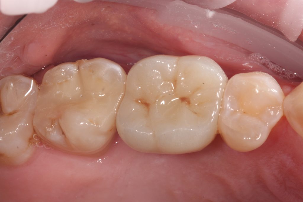 Fig. 12: Finished screw-retained restoration in the mouth showing excellent fit and shape adaptation to the site. The patient is able to maintain the oral hygiene with either flossing, interproximal brushes or electronic interproximal cleaning aids such as Sonicair flosser or Waterpik