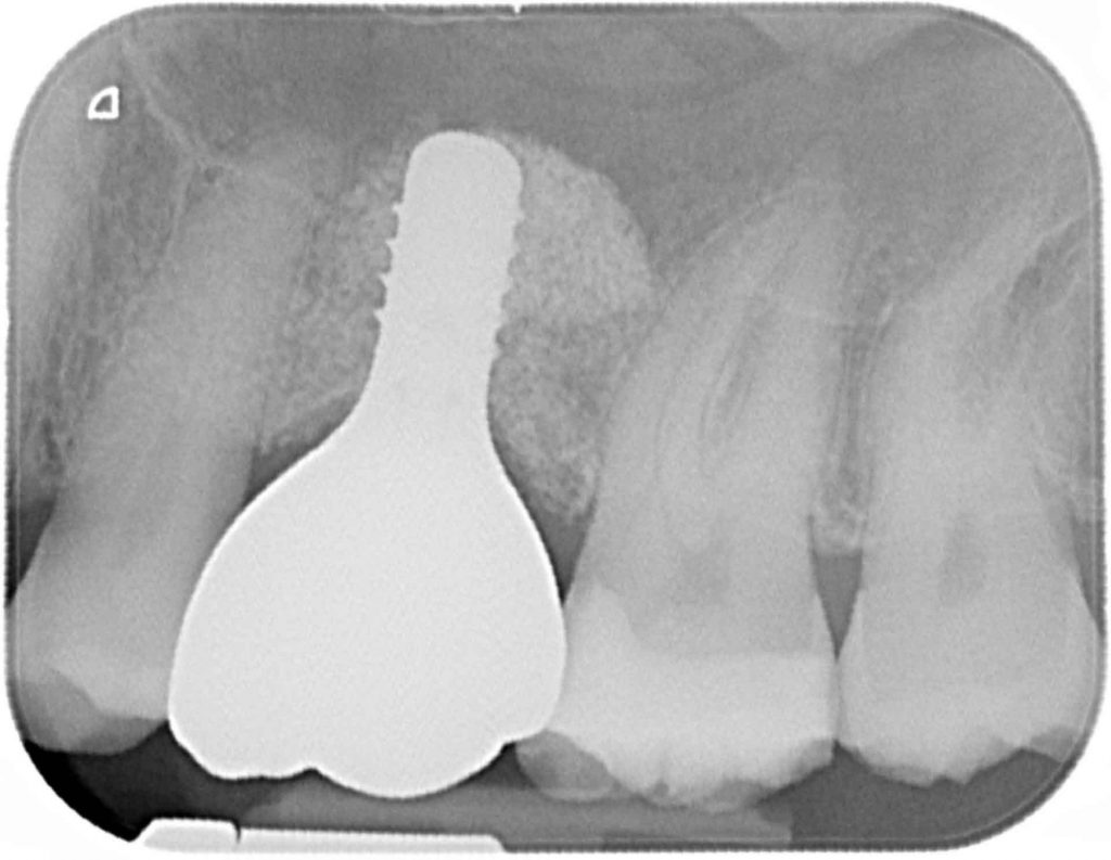 Fig. 13: Post-operative radiograph showing the definitive restoration in situ – the lack of gap between the implant fixture and screw-retained crown confirms excellent marginal accuracy and homogeneity to the restoration and implant fixture