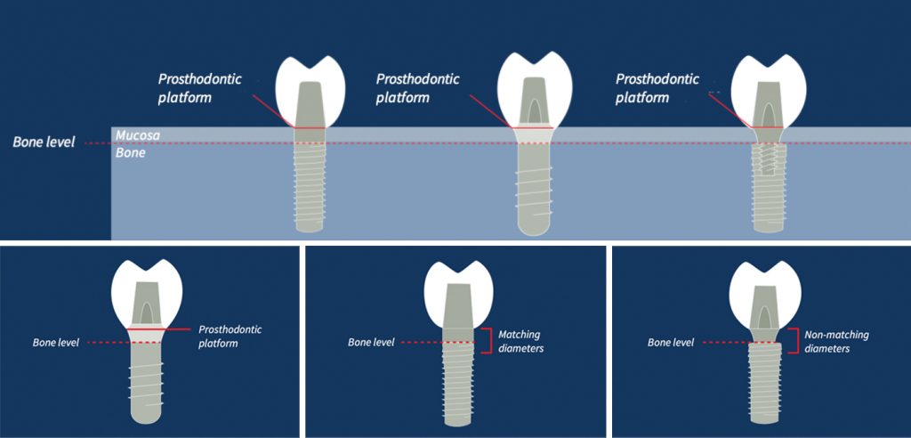 Fig. 2: Variations in implant prosthodontic interface: Screenshots captured from the ITI Academy learning module “Implant Designs and Characteristics” by Christoph Hammerle 
