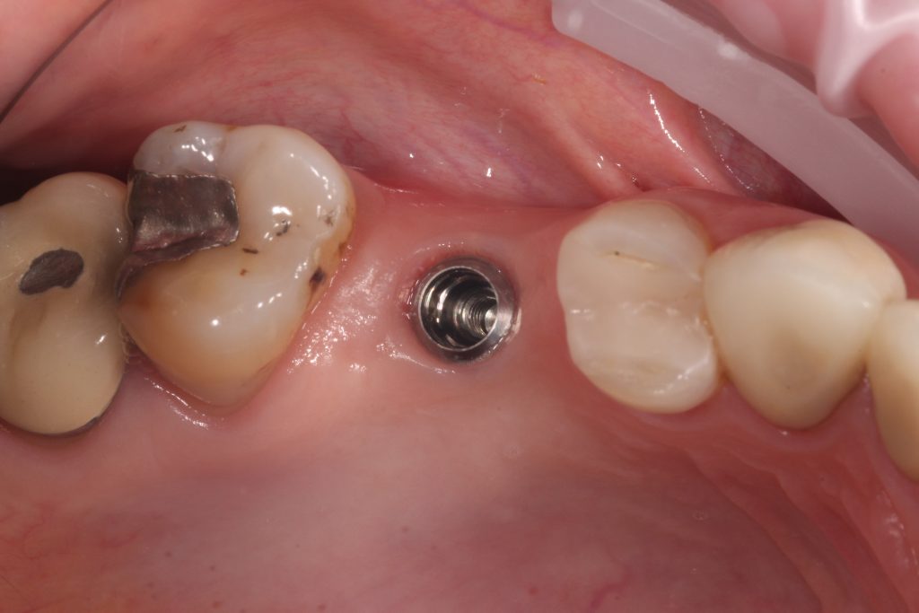 Fig. 4b: Clinical picture showing healthy peri-implant tissues 