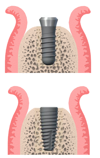Fig. 5: Graphic to demonstrate the difference between the restorative interface of a tissue level and bone level implant. This shows how the bone level can be modified and the tissue level is predetermined