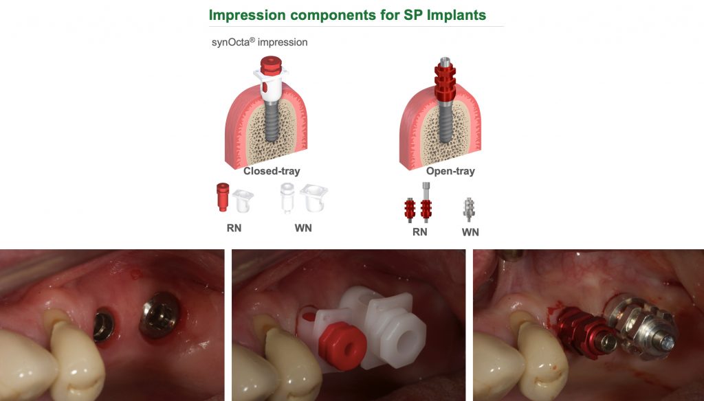 Fig. 6: Schematic to show old style “snap-on” closed tray plastic impression baskets and metal open tray impression copings that can be used with a modified stock tray or individualized special tray