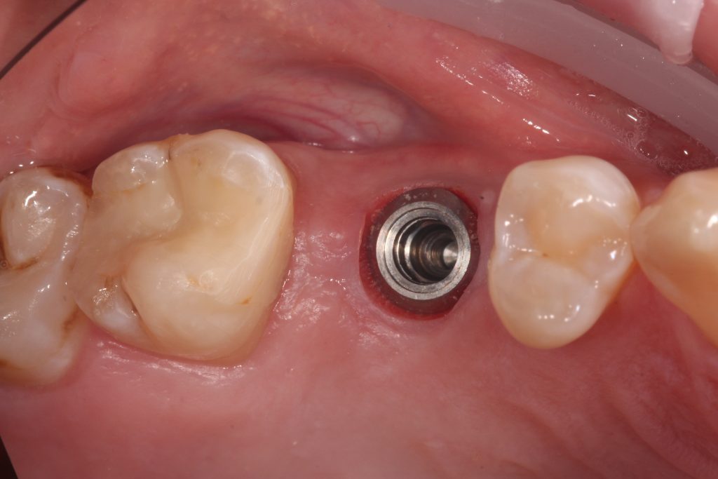 Fig. 7: Wide neck tissue level implant showing a very healthy emergence profile