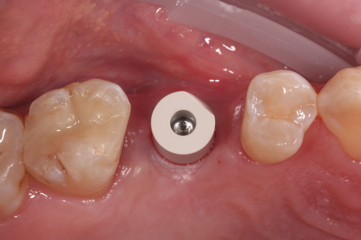 Fig. 8: The Straumann Mono Scanbody is attached in preparation for the digital intraoral scan
