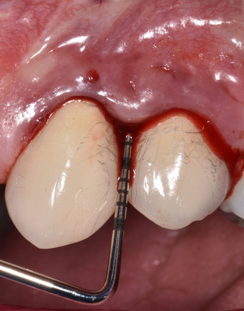 Fig. 3a (left) shows UL3 and UL4 implants with inflamed peri-implant tissues, profuse bleeding on probing and increased probing pocket depth of 7 mm. 