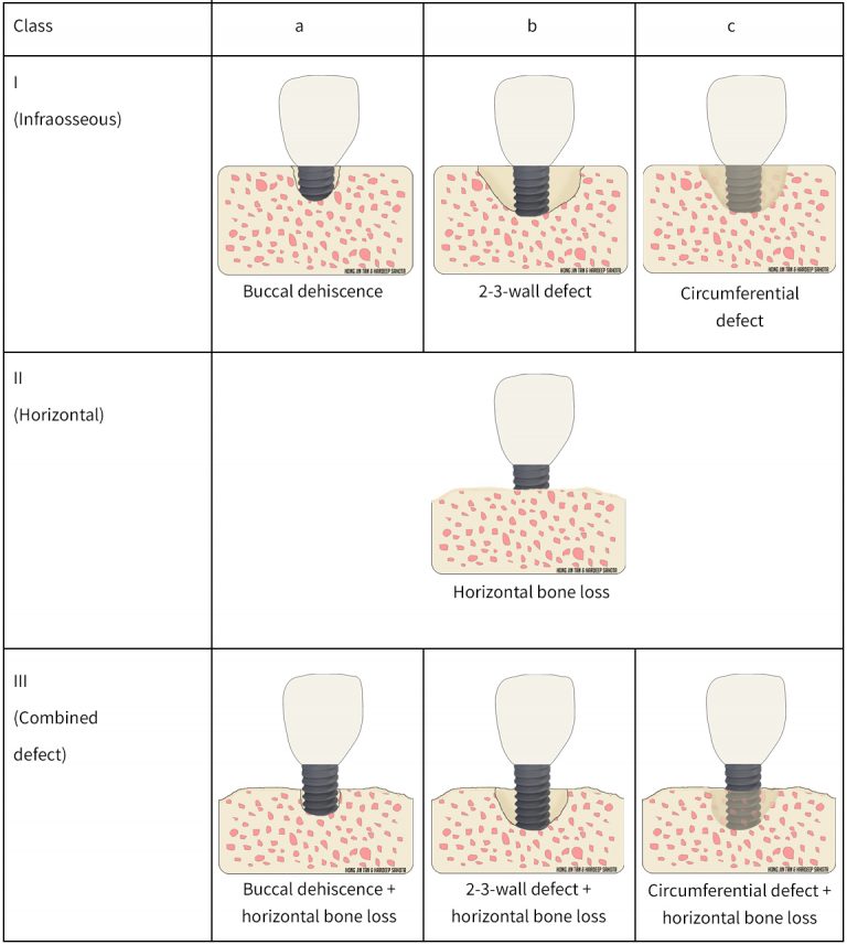 Dental Peri-implant Diseases - ITI Blog