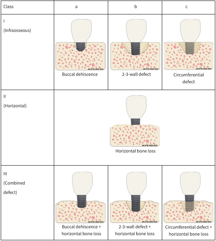 Table 1: Defect classification (diagrams modified from source: Monje et al. 2019)