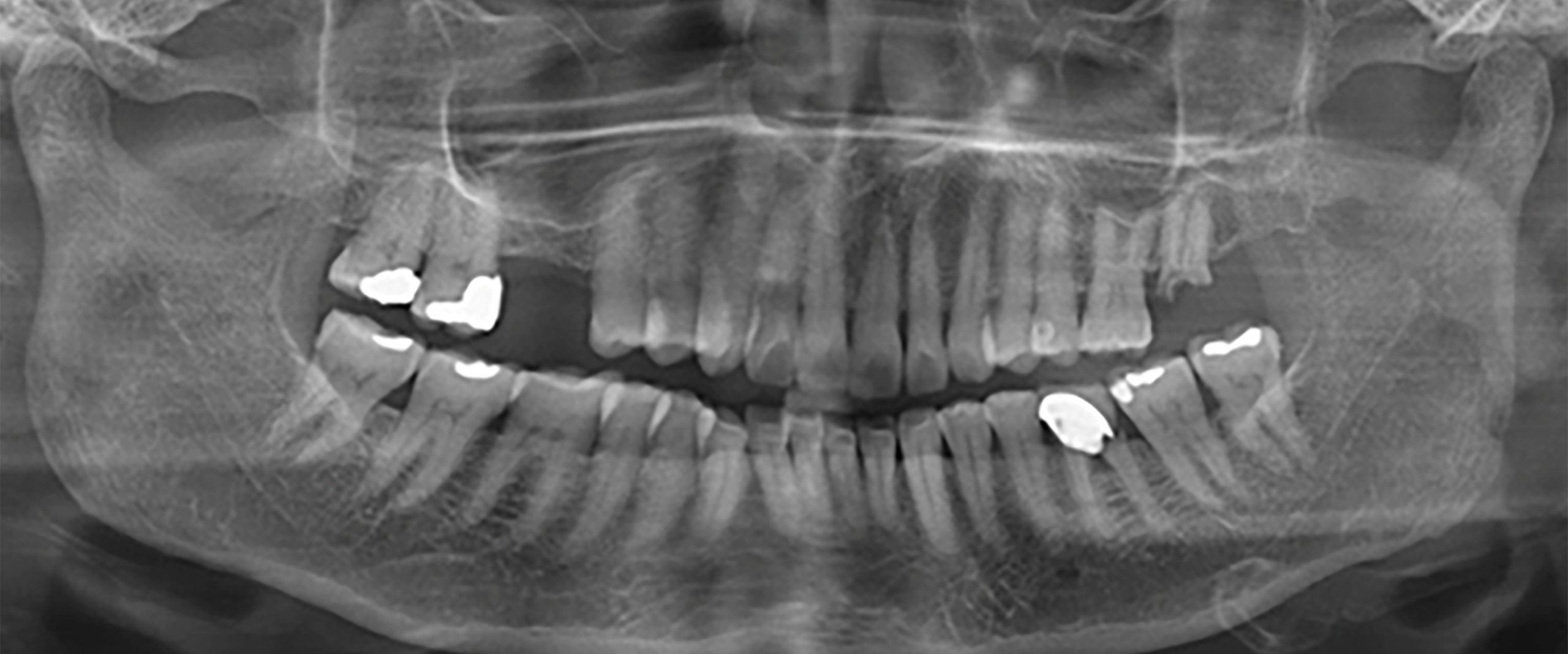 Fig. 1: A 63-year-old woman presented with a hopeless lower left first molar